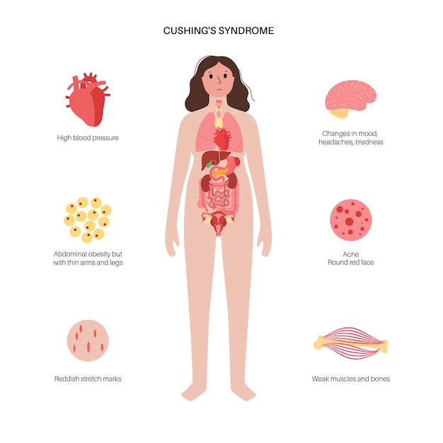 Cushing syndrome disease vector illustration Cortisol in adrenal gland Increased secretion of ACTH