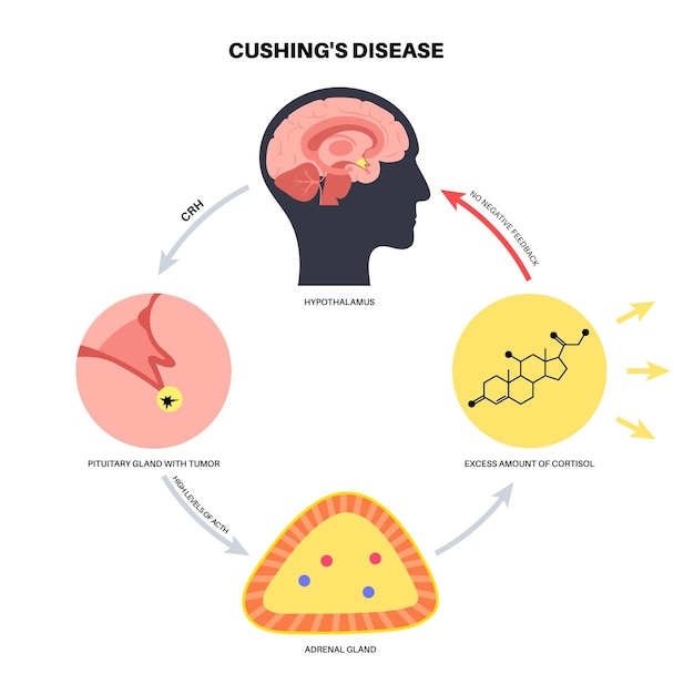 Cushing syndrome disease vector illustration Cortisol in adrenal gland Increased secretion of ACTH