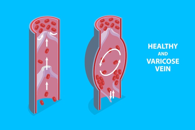 D isometric flat vector illustration of healthy and varicose vein educational medical diagram