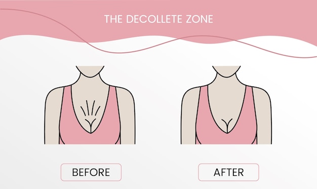 Vector the decollete zone laser cosmetology before procedure and after applying treatment in vector illustration of a woman with smooth clean skin and problematic skin