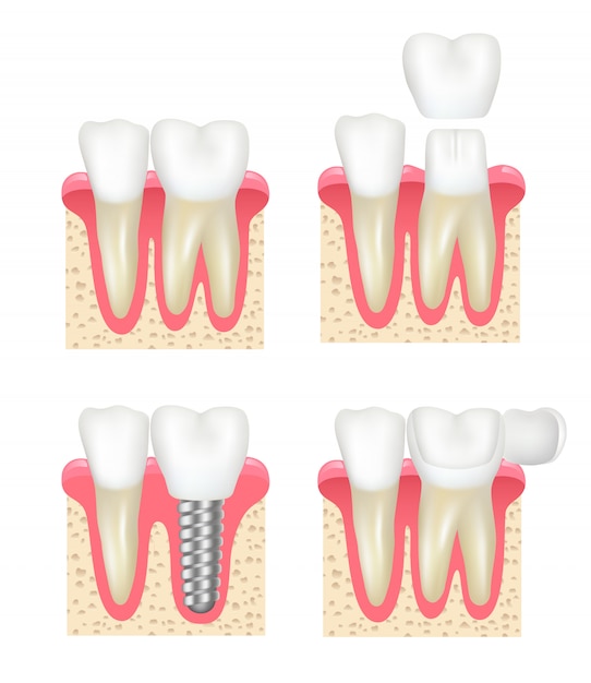 Dental crown. Tooth veneer implants healthy cavity stomatology dentist collection