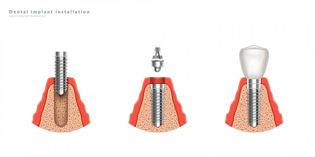 Dental implant installation stages. 3d realistic illustration.