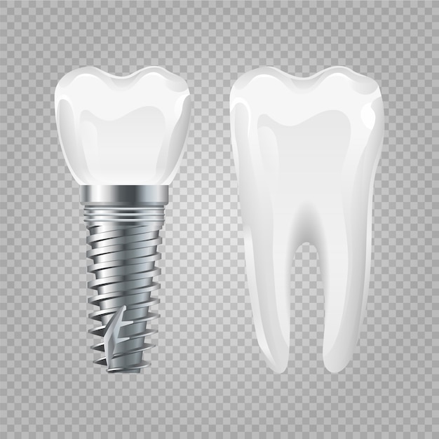 Dental implant. Realistic healthy tooth and implant. dental surgery elements