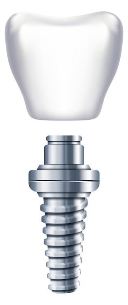 Dental implant scheme Tooth replacement Orthodontic illustration