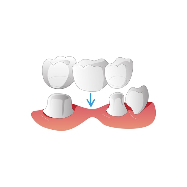 Vector dental implant structure 3