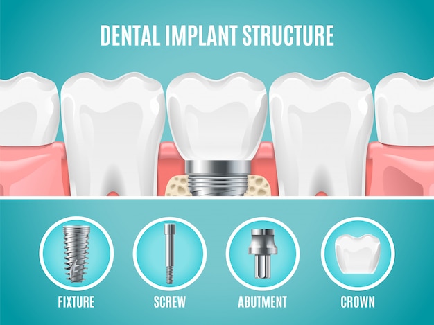 Dental implant structure. reallistic tooth implant cut. Dental surgery banner