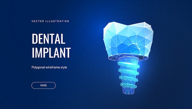 Dental implant with digital technologies in dentistry