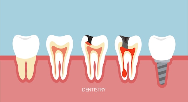 Dentistry for dental disease Implantation Illustration in flat style