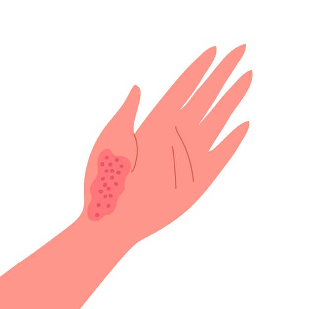 Vector dermatitis on the skin of a human hand