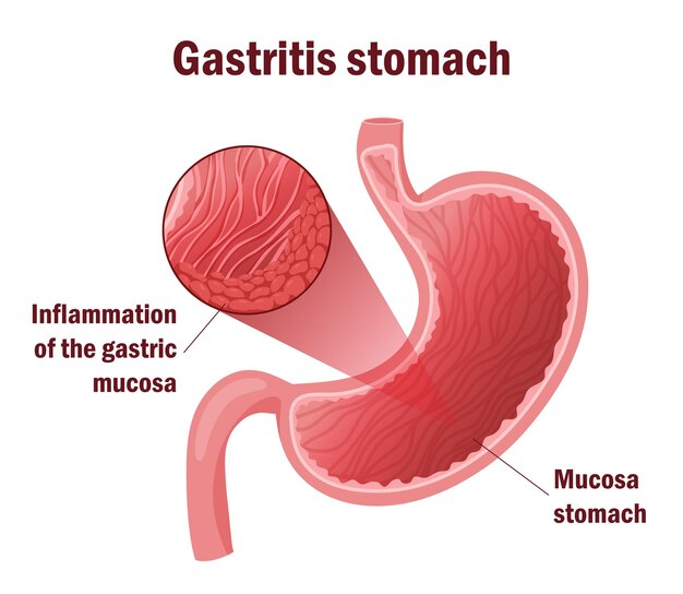 Vector detailed illustration cells inflammation in stomach