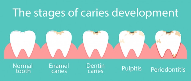 Development of dental caries in the oral cavity.