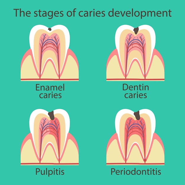 Development of dental caries