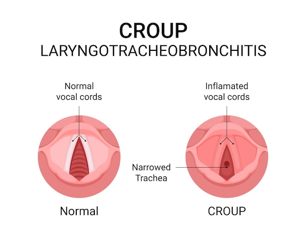 Vector diagram of croup laryngotracheobronchitis