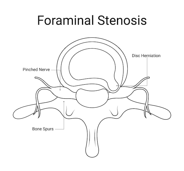 Diagram of foraminal stenosis medical design in line style