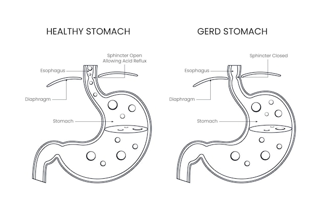 Vector diagram of gerd stomach disease with design line style for medical