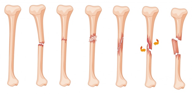 Diagram of leg fracture in different stages illustration