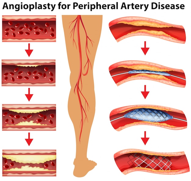 Diagram showing angioplasty for peripheral artery disease