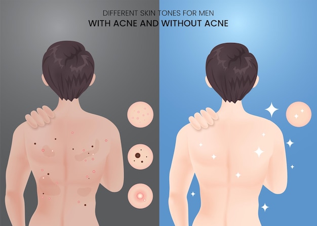 Different skin tones for men with acne and without acne