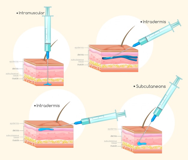 Different types of injections