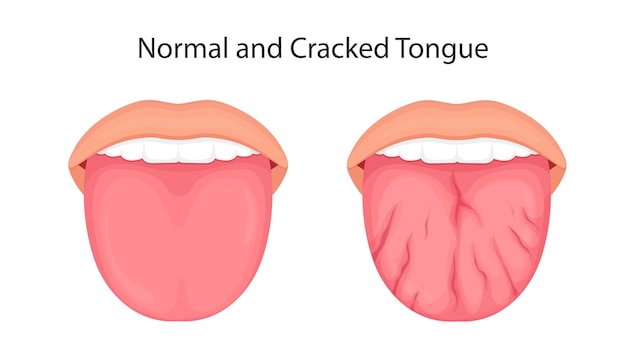 Disease of the tongue cracks medical illustration