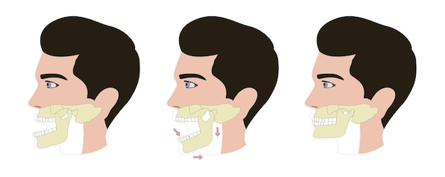 Dislocated Jaw vector illustration first aid