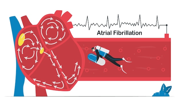 Vector doctor treats a heart disease that is atrial fibrillation. af is common type of irregular heartbeat. electrical signals in atrium cause atrium to beat quickly and erratically. cardiology vector.