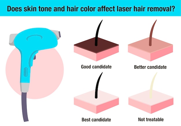 Does skin tone and hair color affect laser hair removal Hair removal laser icon Flat  Cosmetology