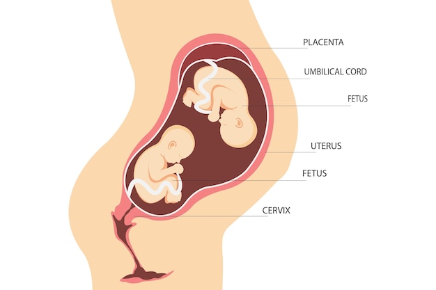 Double pregnancy. Anatomy of the uterus with twin fetuses. Placement of dizygotic twins. flat illust