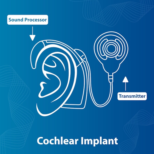 Ear Cochlear Implant device