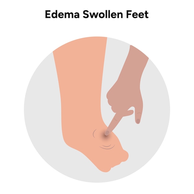 Edema swollen feet