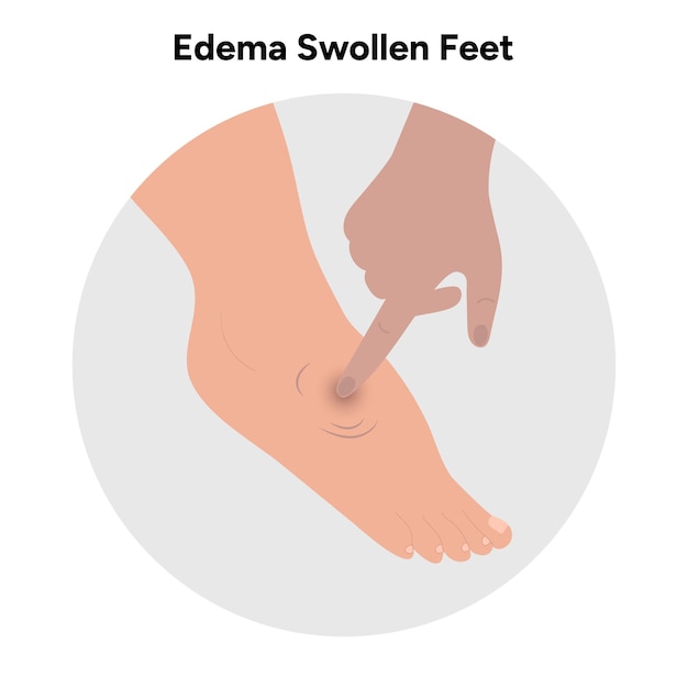 Edema swollen feet