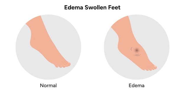 Edema swollen foot and normal foot