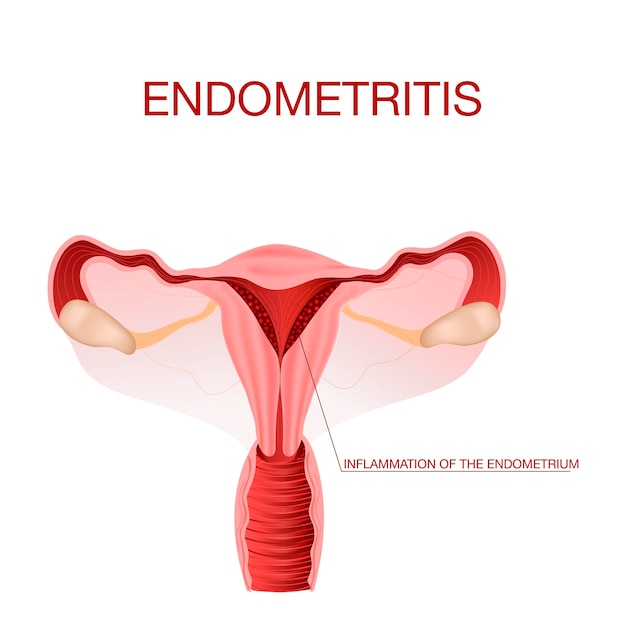 Endometritis inflammation of the uterusInflammation of the endometriumVector illustration