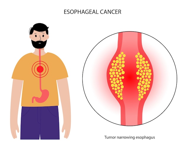 Esophageal cancer concept