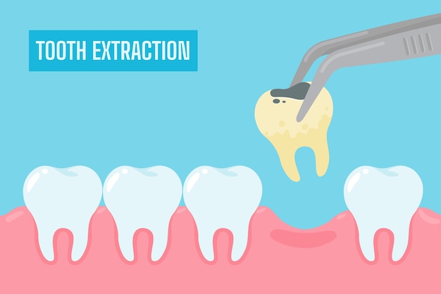 Extraction of teeth. Cartoon yellow teeth with tartar and plaque removed from the oral cavity.