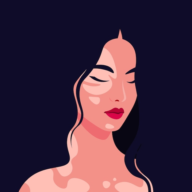 The face of a young Asian woman with vitiligo depigmentation Vector flat Illustration