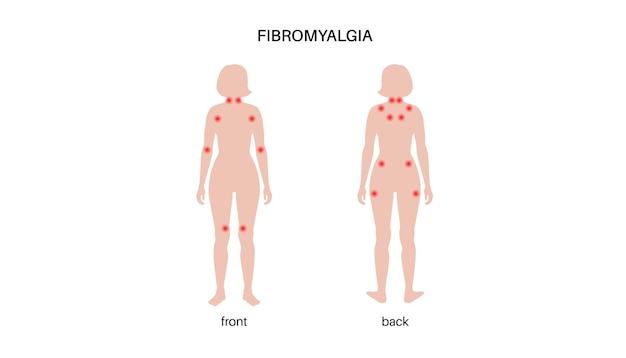 Vector fibromyalgia medical poster