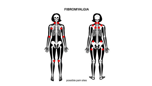 Vector fibromyalgia medical poster