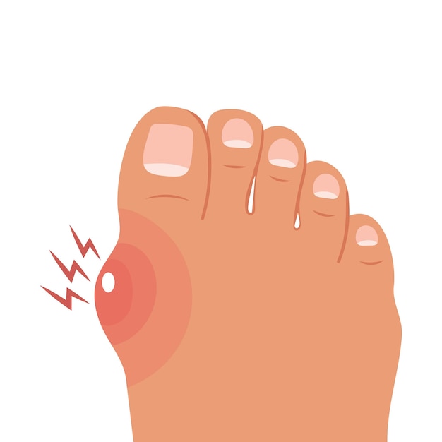 Foot with painful bunion Healthy and sick feet Healthcare and medicine Illustration Vector