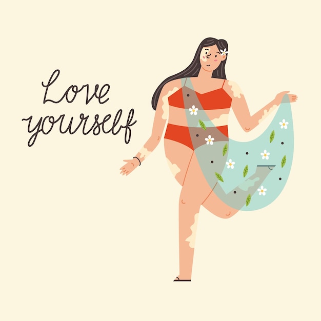 Funny fat girl with vitiligo. Body positive, self love, depigmentation disease, accepting Your Body. International 
 Vitiligo Day. Modern vector illustration in flat hand drawn style