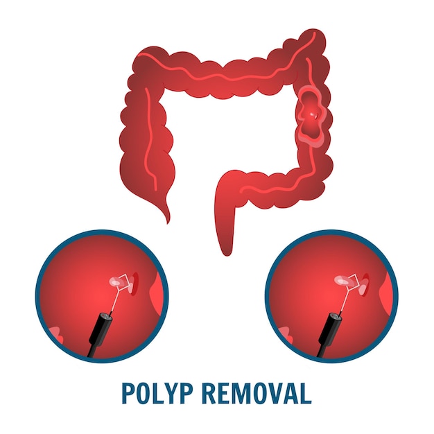 Gastroenterology disease polyp removal in vector illustration