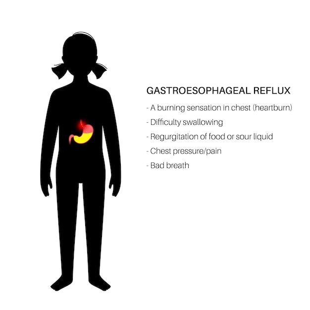 Gastroesophageal reflux disease. Child in clinic. Digestive disorder and GERD in kid body. Pain, heartburn in chest, stomach and esophagus. Open sphincter allows acid reflux flat vector illustration