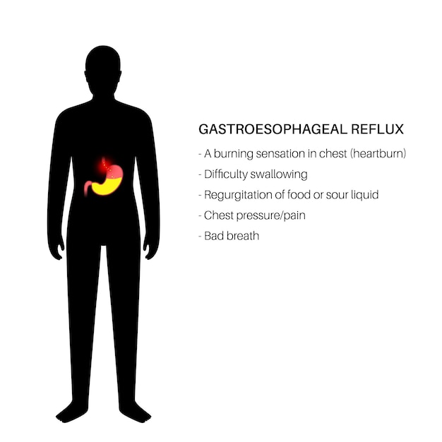 Gastroesophageal reflux disease poster. Digestive disorder and GERD problem in male human body. Pain, heartburn in chest, stomach and esophagus. Open sphincter allows acid reflux vector illustration