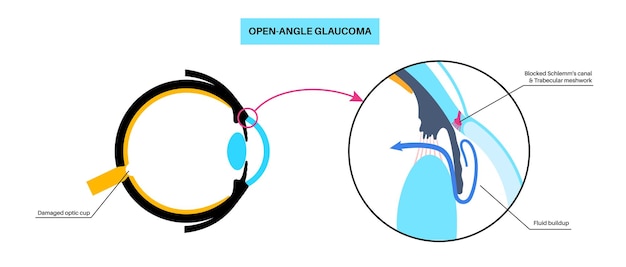 Vector glaucoma eye disease