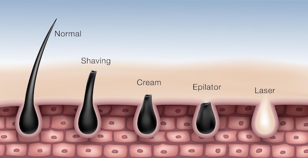 Hair removal comparison chart by shaving waxing depilatory creams epilator and laser hair removal