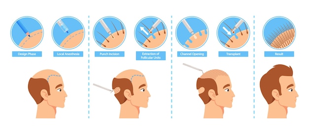 Hair Transplantation Process Infographics Including Design Phase Transplant and Result Stages Before and After Images