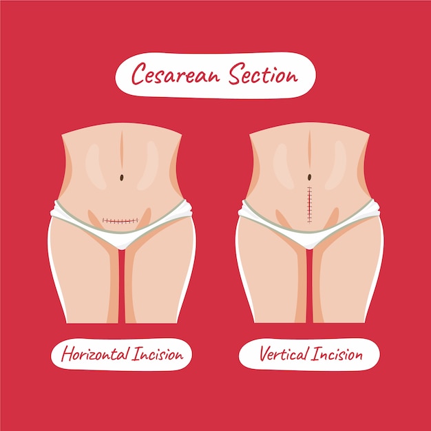 Hand drawn flat design cesarean section