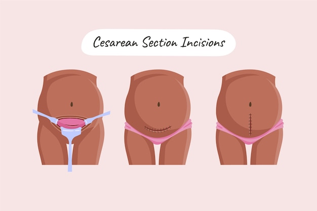 Hand drawn flat design cesarean section