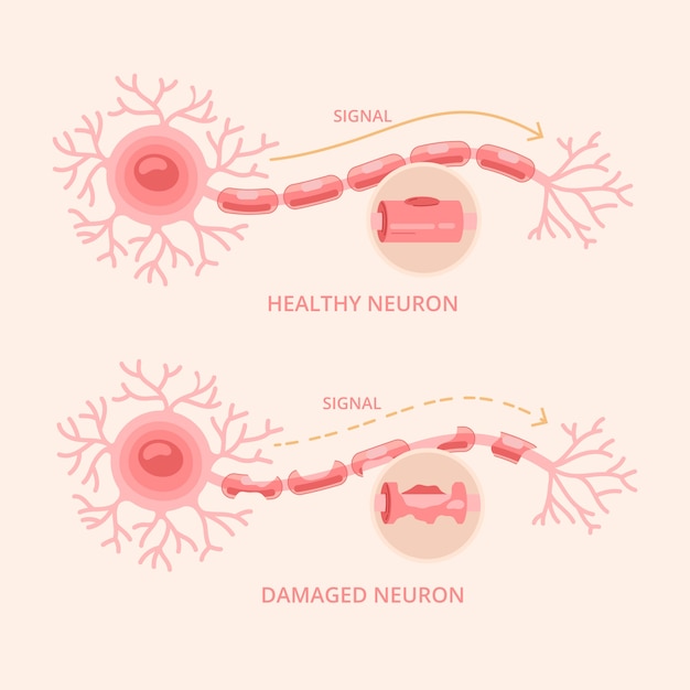 Hand drawn flat design multiple sclerosis illustration