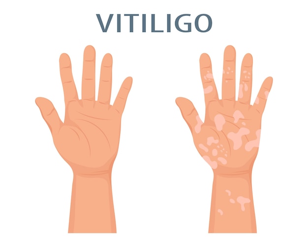 Hands with dermatological disease vitiligo. Medicine concept. World vitiligo day, awareness banner.